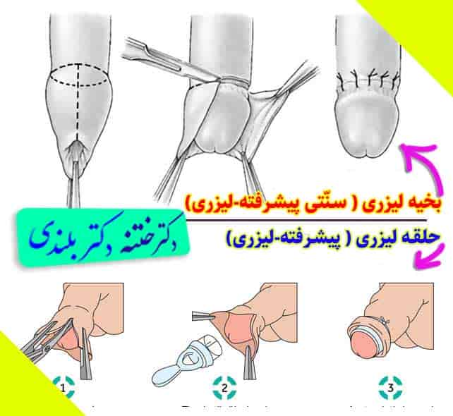 انجام تمام روشهای مدرن ختنه توسط استاد دکتر بلندی